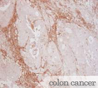 colon cancer